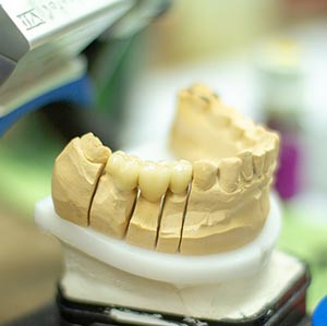 65세 이상 의료급여수급자 틀니 지원